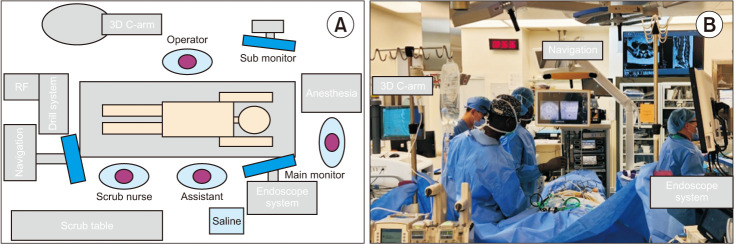 The Use of Computed Tomography-Based Navigation System for Biportal Endoscopic Lumbar Decompression.