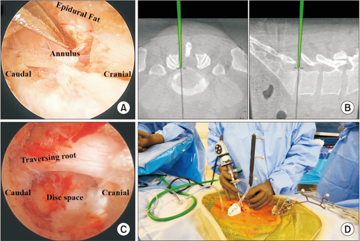 The Use of Computed Tomography-Based Navigation System for Biportal Endoscopic Lumbar Decompression.