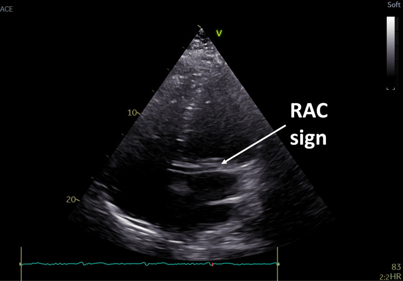 All coronary arteries originating from the right sinus of Valsalva: a multimodality imaging approach.