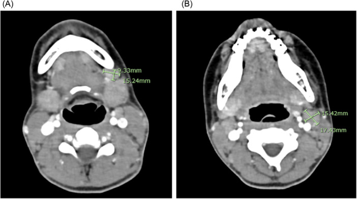 Diagnostic Salivary Gland Biopsy in Pediatric Eosinophilic Granuolmatosis with Polyangiitis.