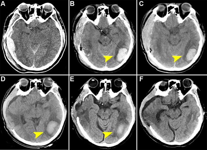 Clinical characteristics and outcomes of patients with traumatic brain injury transferred from ultra-high-altitude areas: patient series.