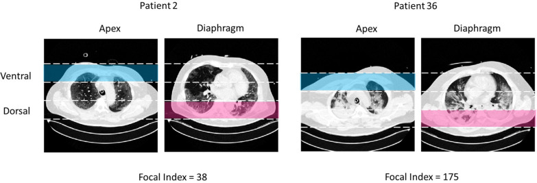 The focal index: a quantitative approach to morphological sub-phenotyping of COVID-19 patients with acute respiratory distress syndrome: a pilot study.