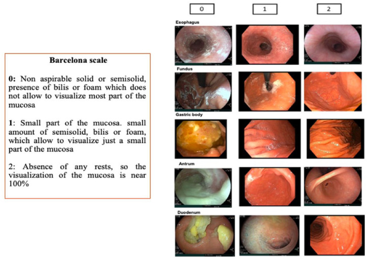 Prospective validation of the Barcelona scale for the assessment of mucosal cleanliness during upper gastrointestinal endoscopy.
