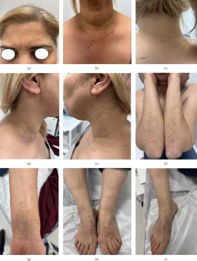 A Patient With Granuloma Annulare and Lichen Planus Treated With Apremilast: A Case Report.