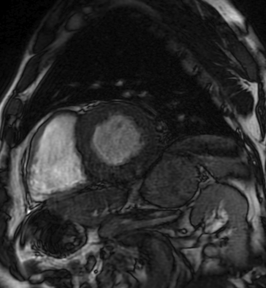 A mutation in transthyretin gene in a Mexican patient leading to hereditary amyloidosis: a case report.
