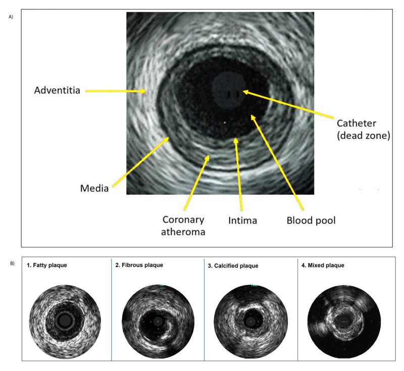 Intravascular Ultrasound Imaging-Guided Percutaneous Coronary Intervention: Evidence and Practical Implications.