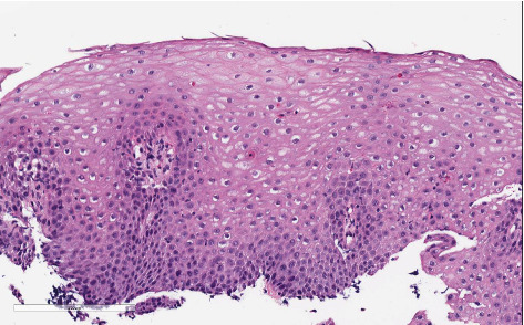 Eosinophilic Esophagitis Complicated by an Esophageal Stricture in a 15-Month-Old Child.