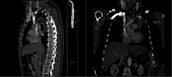 Venovenous extracorporeal membrane oxygenation catheter related superior vena cava syndrome without pre-existing stenosis in an adult patient: a case report.