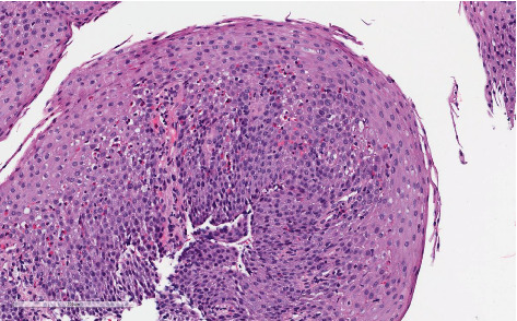 Eosinophilic Esophagitis Complicated by an Esophageal Stricture in a 15-Month-Old Child.