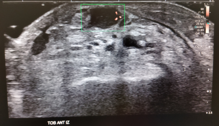 [A particular case of a Schwannoma in the foot].