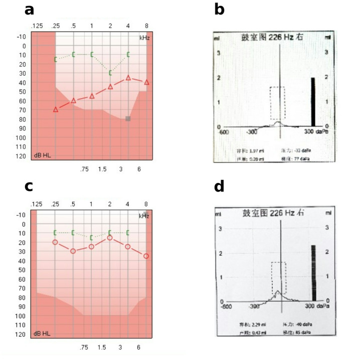 Clinical Audiological Features of Otosclerosis-Preoperative Hearing Analysis in 80 Ears.