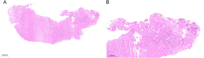 A Rare Case of Long-Term Survival in Stage IIIB Lung Adenocarcinoma: an 9-Year Follow-Up.