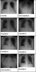 Post-Engraftment Syndrome Following Autologous Haematopoietic Stem Cell Transplantation in a Patient With Relapsed Hodgkin Lymphoma.