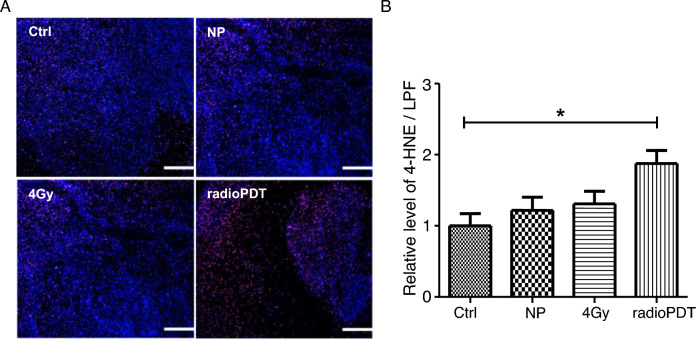Radiation activated photodynamic therapy (radioPDT) induces lipid peroxidation and vascular mediated tumor regression of prostate cancer.