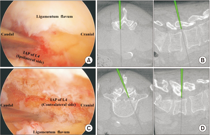The Use of Computed Tomography-Based Navigation System for Biportal Endoscopic Lumbar Decompression.