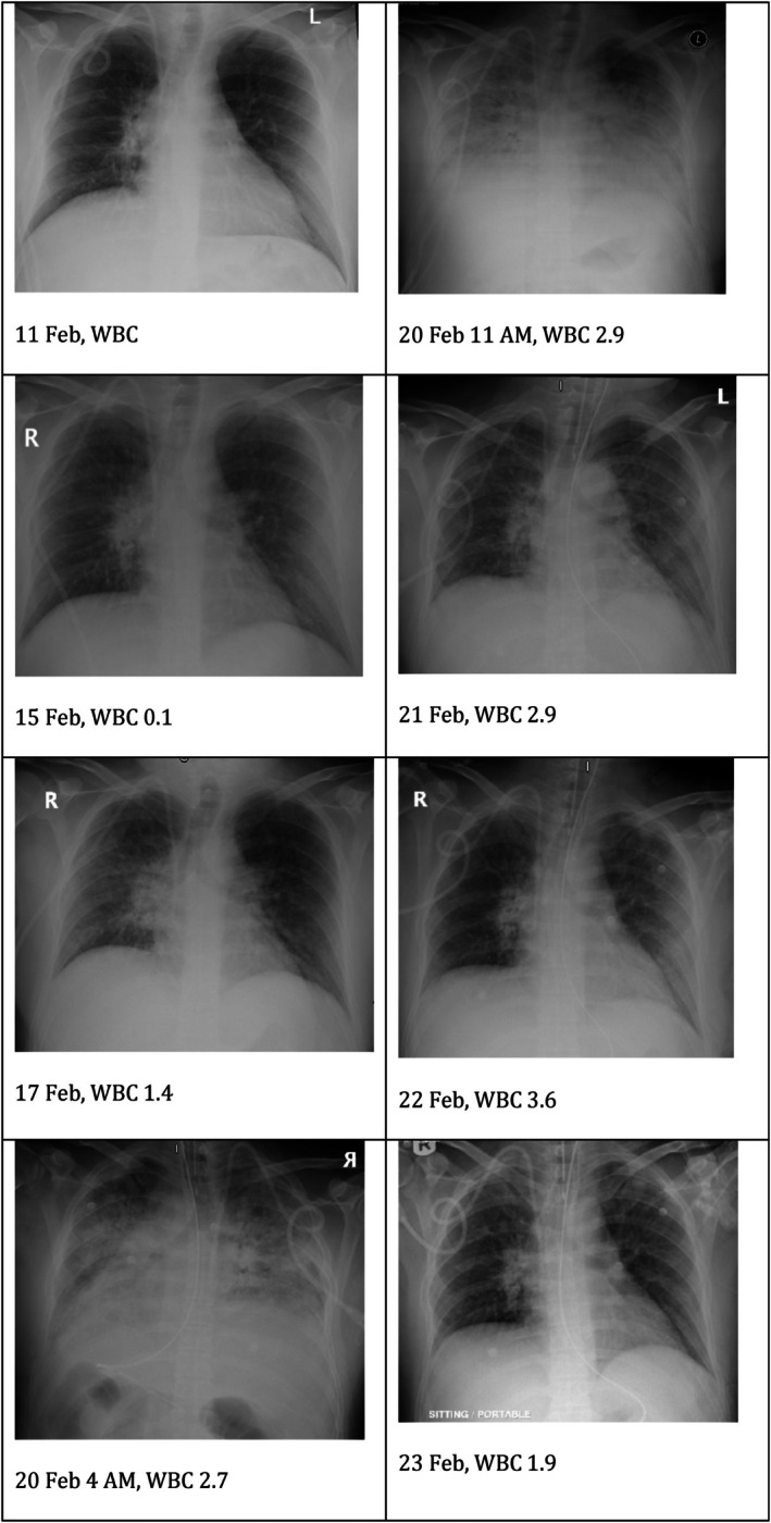 Post-Engraftment Syndrome Following Autologous Haematopoietic Stem Cell Transplantation in a Patient With Relapsed Hodgkin Lymphoma.