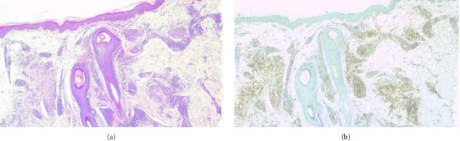 A Patient With Granuloma Annulare and Lichen Planus Treated With Apremilast: A Case Report.