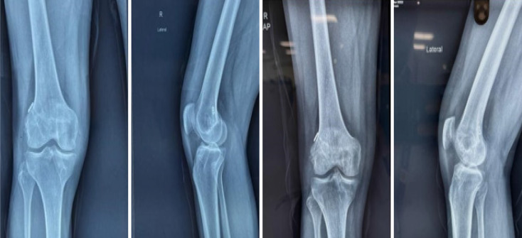 Broken bioabsorbable tibial interference screw post-arthroscopic anterior cruciate ligament reconstruction: A case report.