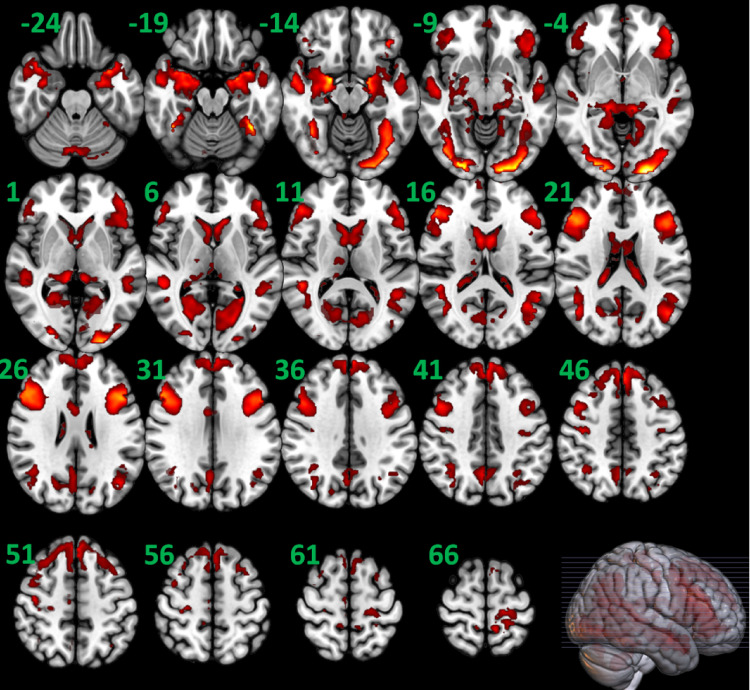 Altered effective connectivity of emotion perception and regulation networks during an emotional face perception task in adults with alcohol use disorder.