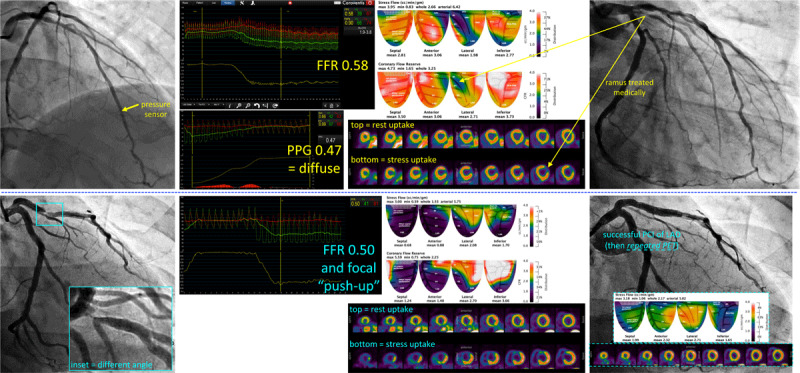 How Different is Invasive Coronary Physiology in the Left Anterior Descending Artery?