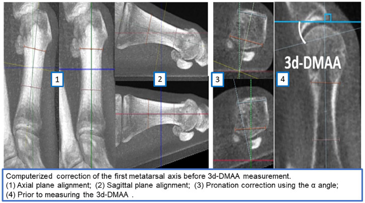 Valgus Deviation of the Intersesamoid Crista in Hallux Valgus and Its Association With the Distal Metatarsal Articular Angle: A Pilot Study.