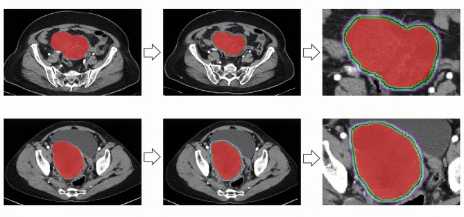 Predicting preoperative lymph node metastasis in patients with high-grade serous ovarian cancer by using intratumoral and peritumoral radiomics: a retrospective cohort study.
