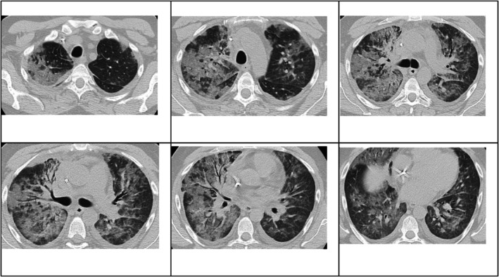 Post-Engraftment Syndrome Following Autologous Haematopoietic Stem Cell Transplantation in a Patient With Relapsed Hodgkin Lymphoma.