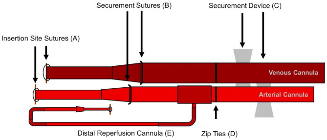 Immediate post-ECPR management strategies in the prehospital and critical care transport medicine environments.