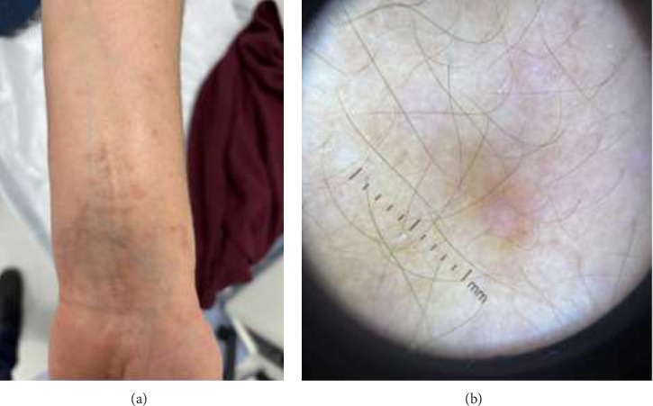 A Patient With Granuloma Annulare and Lichen Planus Treated With Apremilast: A Case Report.