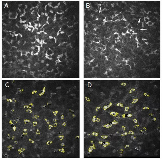 Ocular and confocal manifestations of Mainland Chinese with Fabry disease: a cross-sectional controlled study.