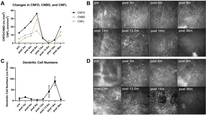 Corneal neurotization meets COVID-19: a case report of minimally invasive corneal neurotization complicated by COVID-19-related keratitis.