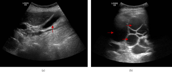 Acute Pancreatitis as a Complication of a Hydatid Liver Cyst.
