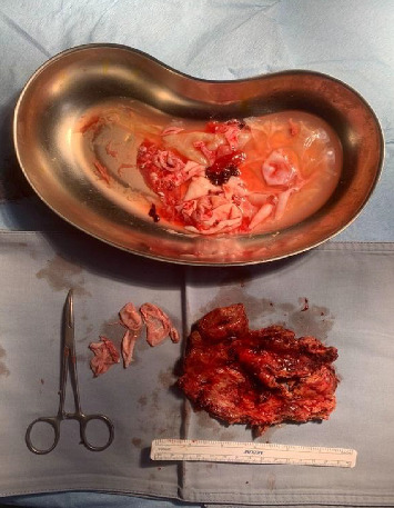 Acute Pancreatitis as a Complication of a Hydatid Liver Cyst.