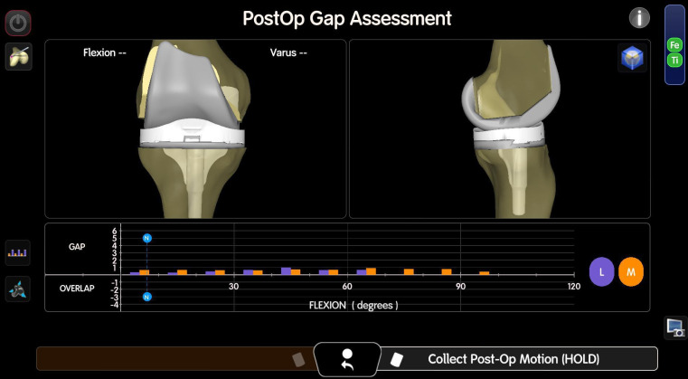 Grading medial compartment tightness among varus osteoarthritic knees during image-free robot-assisted total knee arthroplasty for optimized pre-resection gap balancing.