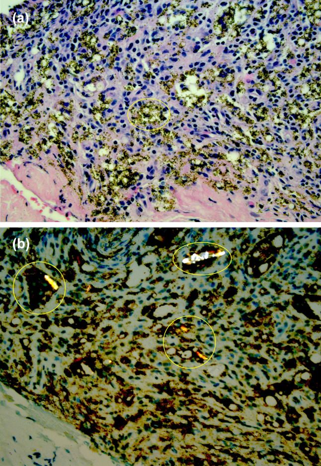 Pigmented, Birefringent Material Causing Nasolacrimal Duct Obstruction.