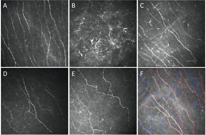 Ocular and confocal manifestations of Mainland Chinese with Fabry disease: a cross-sectional controlled study.