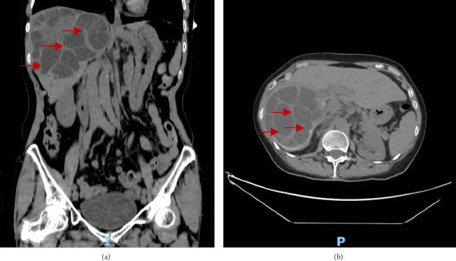 Acute Pancreatitis as a Complication of a Hydatid Liver Cyst.