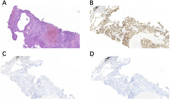 Application of TRPS1 in ER-negative or low expression distant metastatic breast carcinoma.