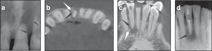 Expert consensus on the diagnosis and treatment of cemental tear