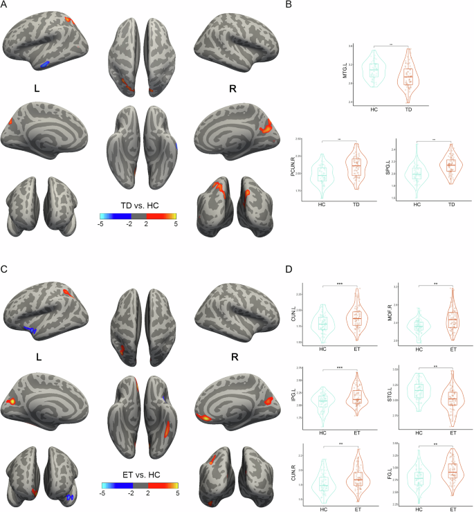 Unraveling morphological brain network disparities Parkinsonian tremor from essential tremor: an artificial intelligence approach for clinical differentiation