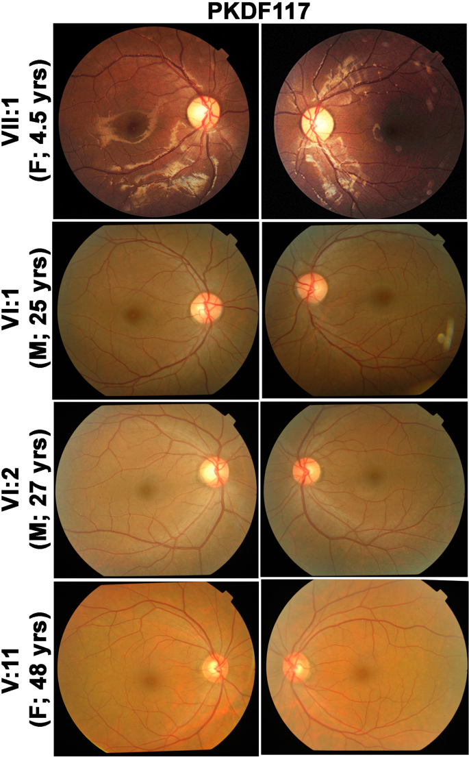 Author Correction: Alterations of the CIB2 calcium- and integrin-binding protein cause Usher syndrome type 1J and nonsyndromic deafness DFNB48