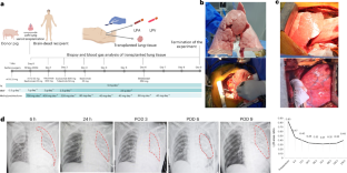 Pig-to-human lung xenotransplantation into a brain-dead recipient