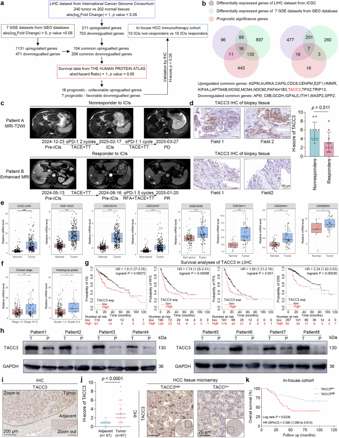 Transforming acidic coiled-coil-containing protein 3-mediated lipid metabolism reprogramming impairs CD8+ T-cell cytotoxicity in hepatocellular carcinoma
