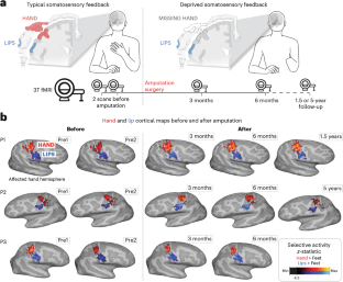 The brain’s body map does not forget lost limbs
