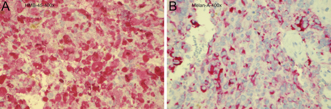 Pancreatic Metastasis From a Vulvar Melanoma Diagnosed by Endoscopic Ultrasound-Guided Fine-Needle Biopsy.