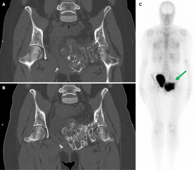Rethinking the role of bisphosphonates after denosumab treatment in locally advanced or unresectable aneurysmal bone cysts: A meta-analysis.