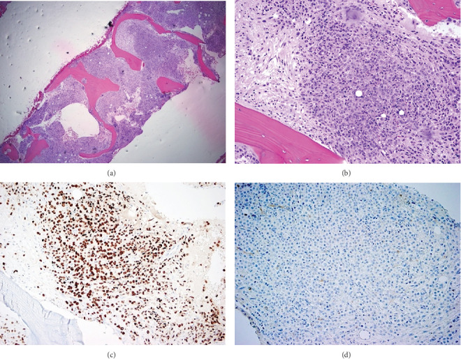 Leptomeningeal Carcinomatosis and Myelophthisic Anemia as Initial Manifestations of Metastatic Lobular Breast Cancer.