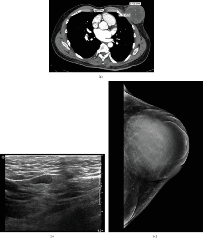 An Advanced-Stage Encapsulated Papillary Breast Carcinoma in a Male: A Case Report.