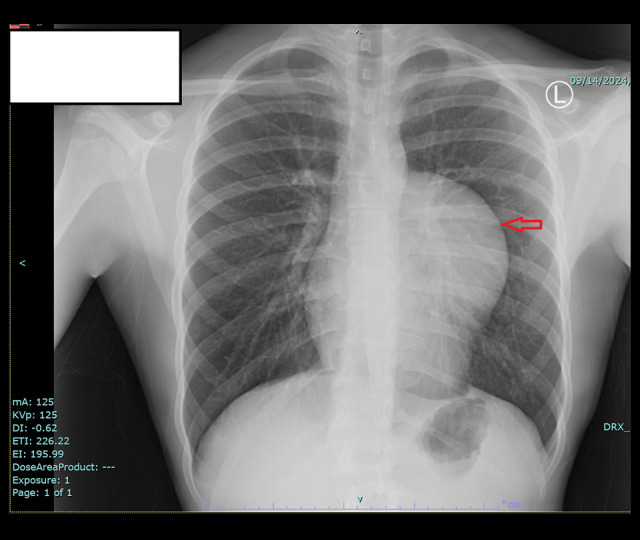 Thoracoscopic Approach for Treating a Primary Hydatid Cyst in the Thymus in a Teenager: A Case Report.