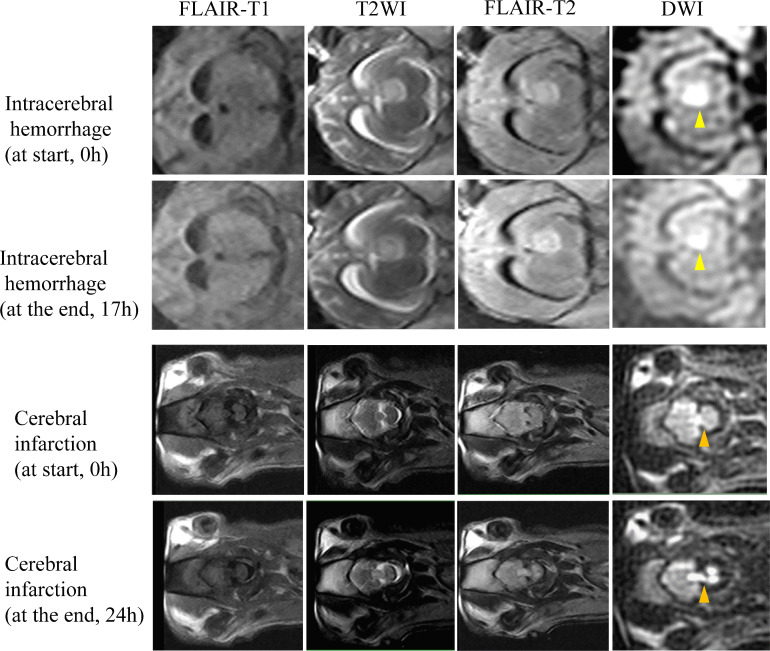 0.23-Tesla MRI to differentiate between ischaemic and haemorrhagic strokes within 24 hours of onset: a combined experimental-clinical study.